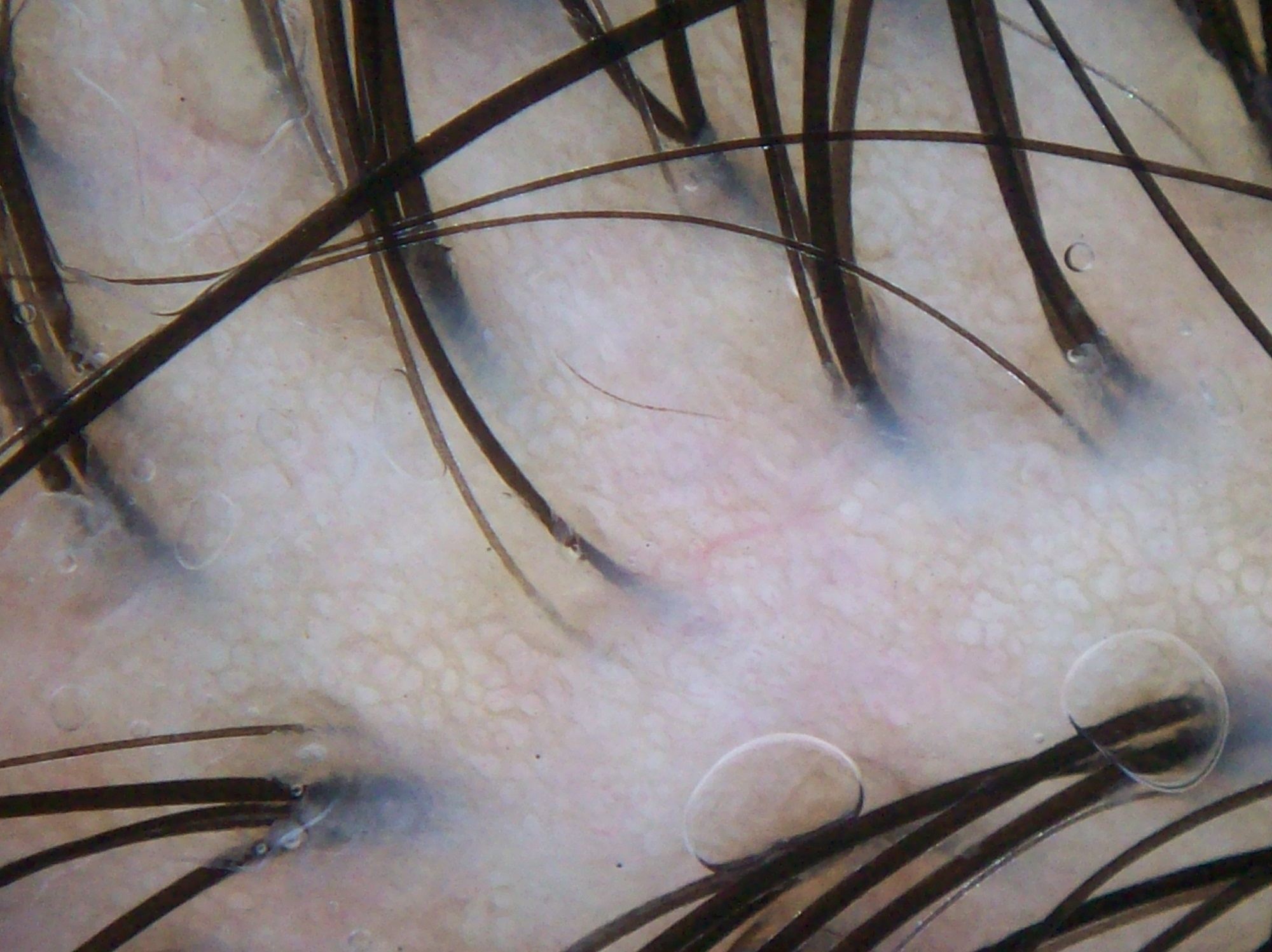 Tricoscopia